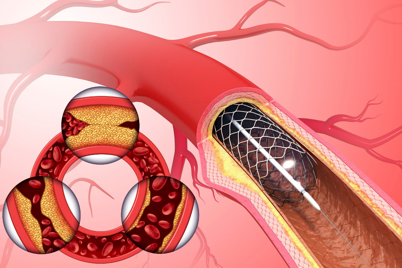 CMS Updates Medicare Coverage for AI-Coronary Plaque Analysis